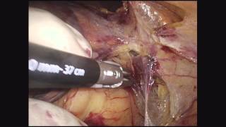 Nefrectomia Mano asistida Izq.