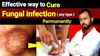 Best antifungal cream for fungal infection ( ringworm) | how to get ride of fungal infection