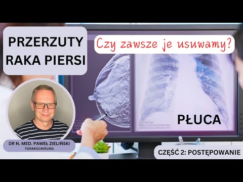Odcinek 148. Czy zawsze usuwamy przerzuty raka piersi do płuc?
