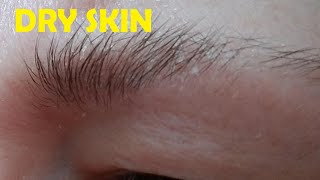 how to get rid of dry skin under eyebrows