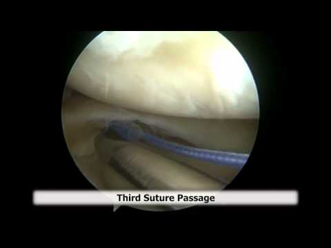 Transosseous Sutures Repair For Meniscal Root Tears