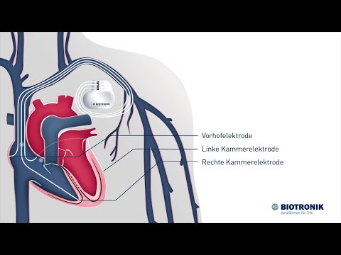 CRT Therapie bei Herzschwäche (Animation Medizin)