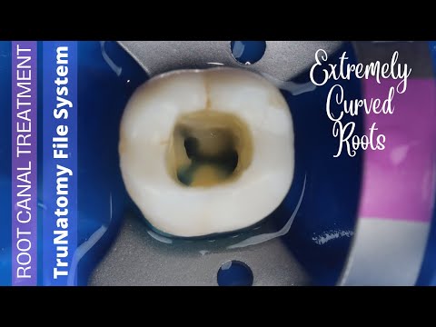 Root Canal Treatment in Mandibular Molar ⚪️ TruNatomy Endodontic File System (Denstsply) 🟡