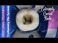 Root Canal Treatment In Mandibular Molar ️ TruNatomy Endodontic File System Denstsply