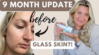 Tretinoin 9 Month Progress Update | My Skin Has Never Been SO Clear!!!