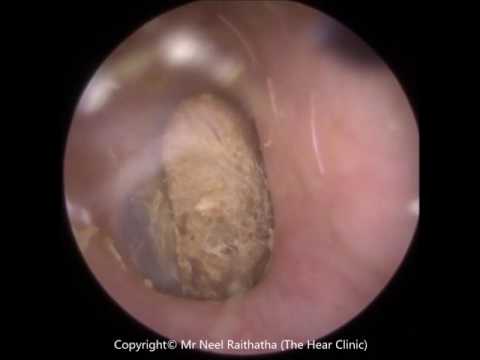 download lagu mp3 mp4 Q Tip Ear, download lagu Q Tip Ear gratis, unduh video klip Q Tip Ear