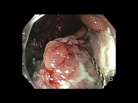 Colonoscopy: Cecum - Large EMR for 2 hours