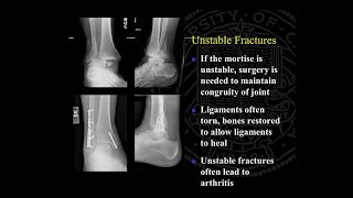 Ankle Replacement and Ankle Fusion: Surgery and Recovery