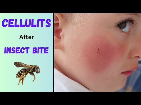 Cellulitis after insect bite | Soft tissue infection | Symptoms, diagnosis & treatment