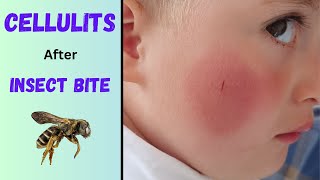 Cellulitis after insect bite | Soft tissue infection | Symptoms, diagnosis & treatment