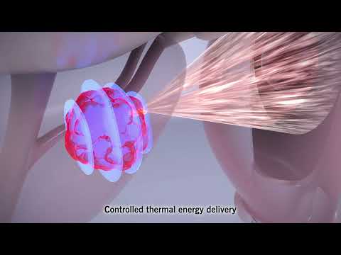 Focal One® High-Intensity Focused Ultrasound