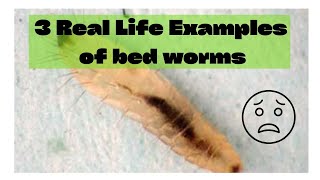 3 Real Life Examples of Bed Worms and What to Do if You Find One