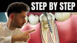 Watch This Before Getting a ROOT CANAL