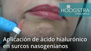 Aplicación de ácido hialurónico en surcos nasogenianos (17038)