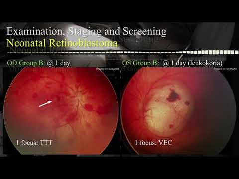 Retinoblastoma: Neonatal Disease - Dr. Tero Kivela