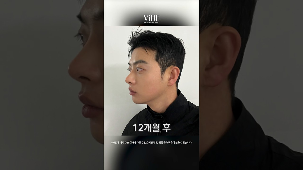 남자 코성형 전후비교! 여기서 더 잘생겨진다고..?｜이마축소, 매부리코