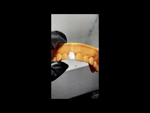 Răng sứ kim cương