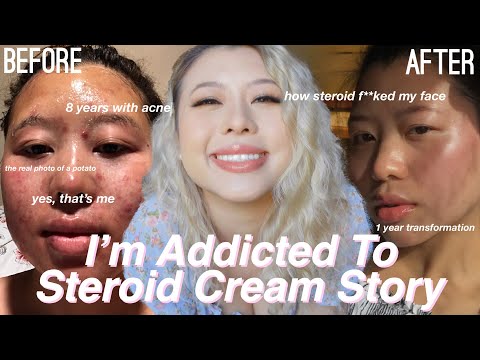 I USED STEROID CREAM FOR 7 YEARS WITHOUT KNOWING | MY ACNE STORY