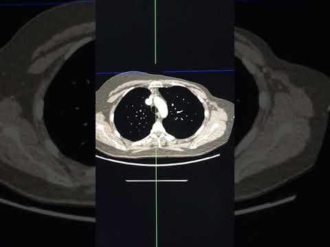 CT assessment - looking at internal thoracic arteries