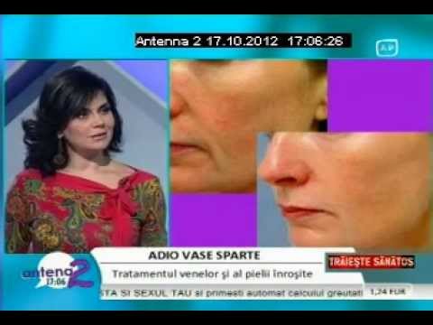 tratamentul denas al varicozei