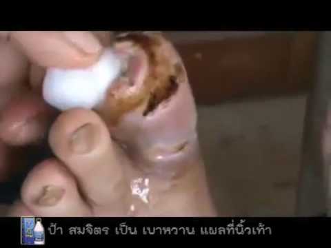 ทั้งโดยการทำครีมสำหรับโรคสะเก็ดเงิน เหนื่อยของโรคสะเก็ดเงิน
