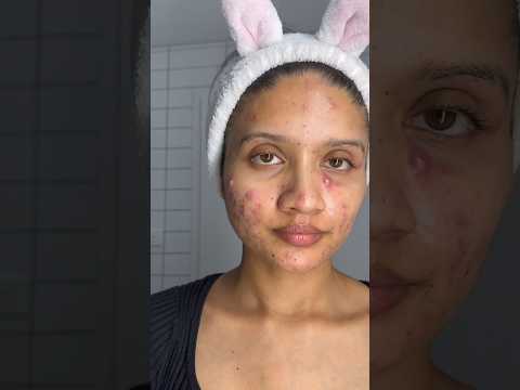 Day 1 to Week 6 on Accutane. It’s been a tough journey #accutane #acne #acnetreatment #cystic #acnes