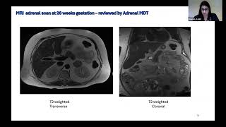 Part 2 of the adrenal day with three clinical cases