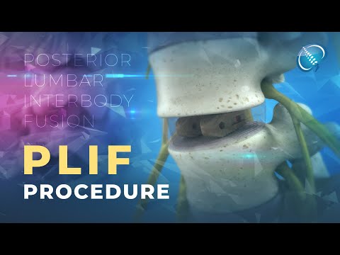 What is Posterior Lumbar Interbody Fusion? | PLIF