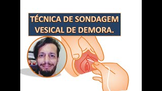 Sondagem vesical de demora - SVD - Técnica circuito fechado.