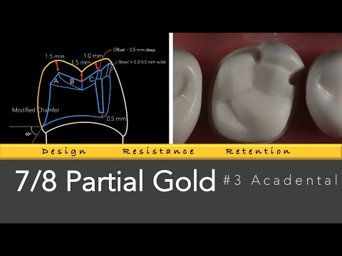 7/8 Gold Partial Veneer #3 Acadental | Gold Coverage Restoration