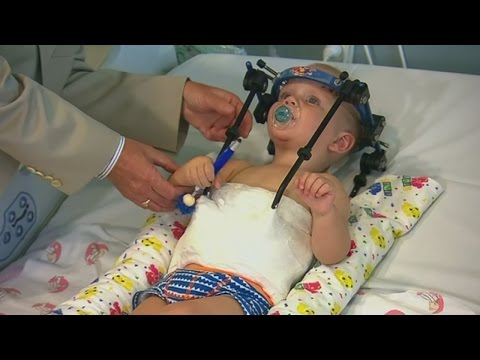 Toddler's head reattached by doctors in medical miracle