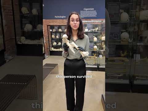 What is a malunion femur fracture?