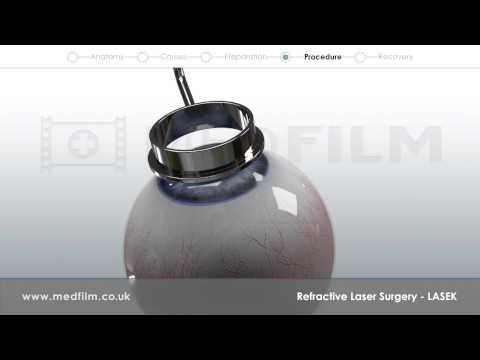 Patient Film: LASEK