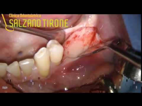 Tintura da malattie delle articolazioni Sciatica lombare terapia a base di erbe