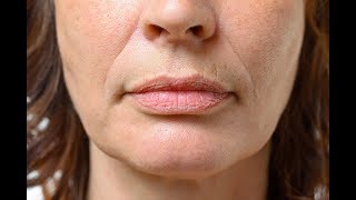 How to get rid of wrinkles around your mouth and lips NATURALLY!