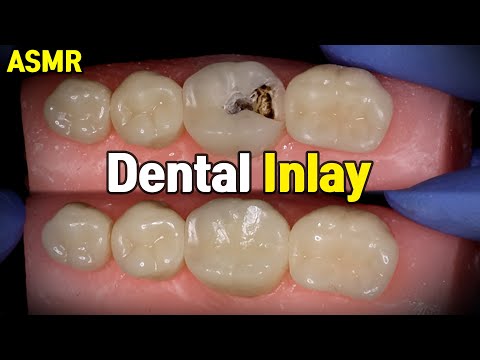 Dental Inlay Procedure