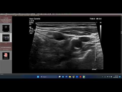Doppler pitfalls of Carotid stenosis 2