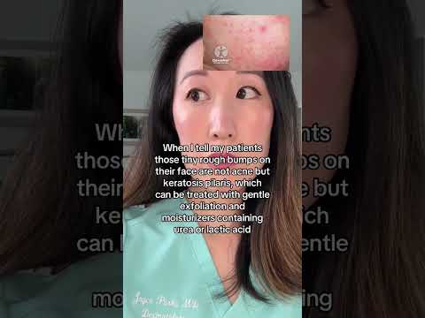 Those Tiny Bumps on Your Face? It’s KP, Not Acne – Here’s What to Do