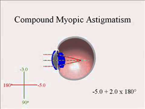 Miopie hipermetropie astigmatismul este