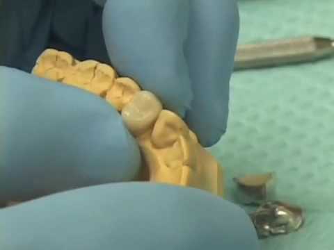 Fabricating Provisional Crowns