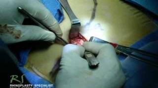 OR Video Footage: Dr. Nassif Revision Rhinoplasty