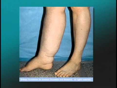 TGMC To Your Health~ Lymphedema Causes and Treatments Part 1 (12/11/13)