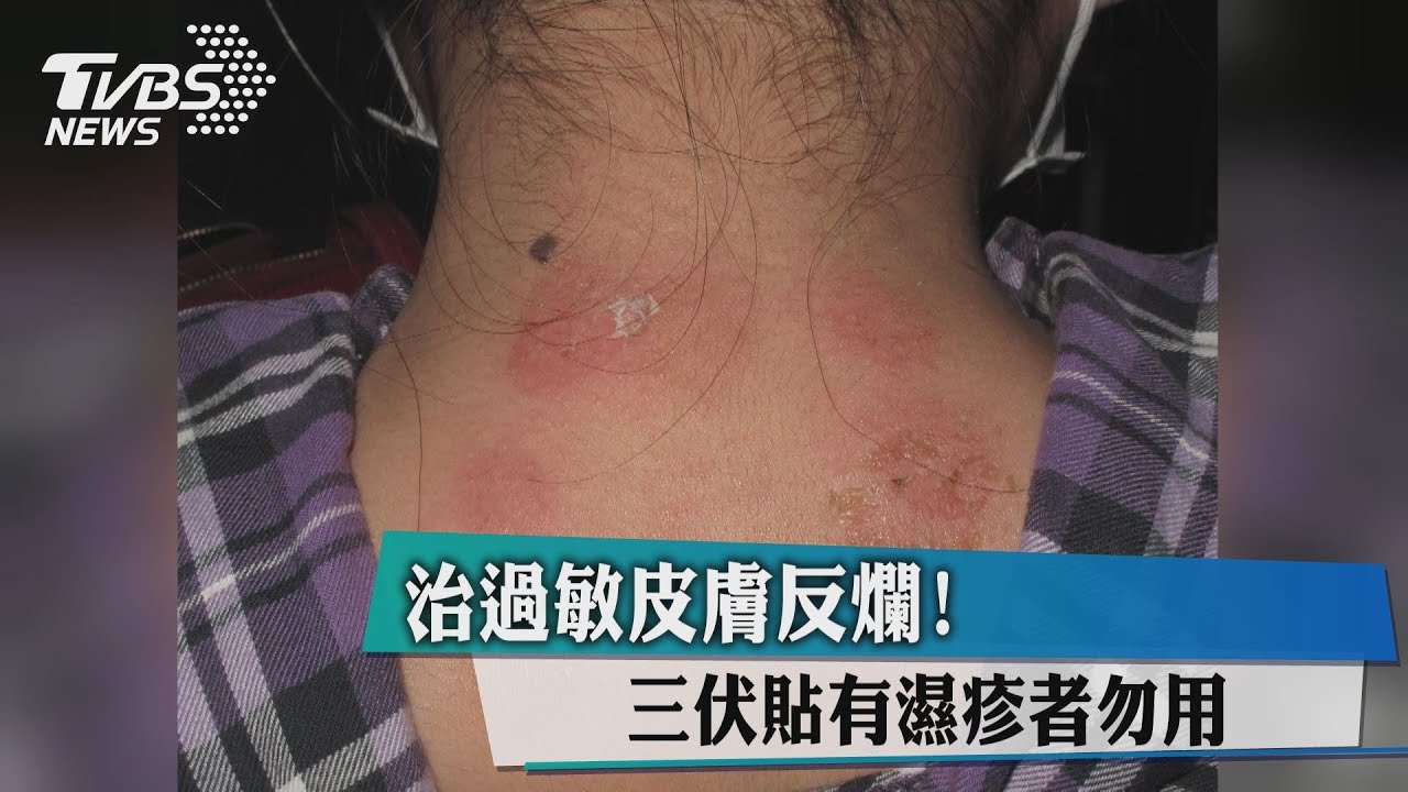治過敏皮膚反爛　三伏貼有濕疹者勿用