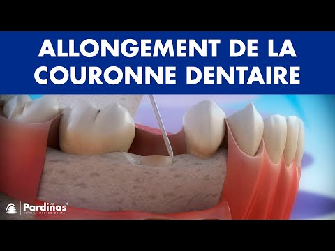 Allongement de la couronne dentaire ©