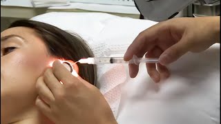 Intra-Tympanic Steroid Injection for Sudden Hearing Loss