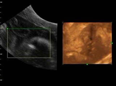 02/02/2008 3D Sonogram #1