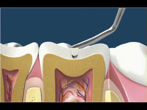 Inlay Filling