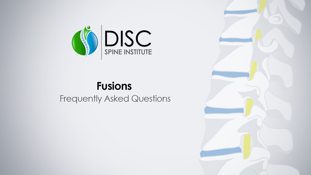 Spine fusion video thumbnail