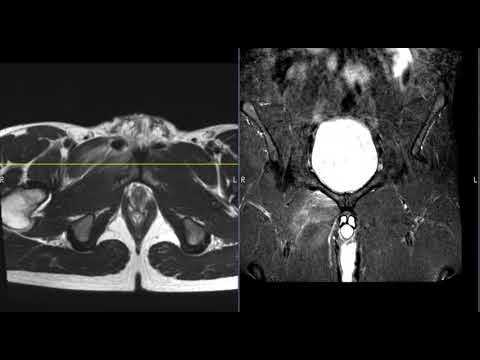 Groin pain. Suspected hernia.