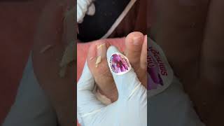 Ep_8191 Ingrown toenail removal 👣 Long nails.. Why do they hurt if I don't cut them? 😄 (Clip from...